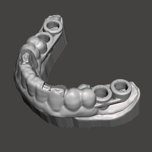SURGICAL SPLINT FOR GUIDED SURGERY 3D model