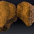 ps14.jpg 3D Alchoholic liver disease cirrhosis hepatitis fatty model