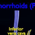 Piles_2173.jpg hemorrhoids piles 3D model