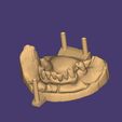 Clipboard-2024-12-21-00-17-00.jpg DIGITAL FLEXIBLE PARTIAL DENTURES upper + lower (3D models !!!) - 12 stl files for download