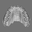 df28b05b-1b24-4ea2-8c5d-50289396c3d1_-2021-04-10_11-46-26-_upper_quadrant_snapshot.jpg SUPERIOR MAXILLARY from Intraoral Scan - AREA3D- Patient A. TOP DENTURE