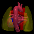 13.png 3D Model of Ventricular Septal Defect