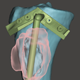 t1.png Osteossarcoma da tíbia