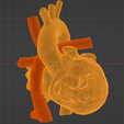 10.png 3D Model of Heart after Fontan Procedure