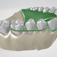 Removable-Palatal-Expansion-Appliance,-molar-distalizer,-teeth,-dental,-tooth,-palatal-expander,-app.png Aparato de Expansión Palatal Removible (KDE) en Dientes Superiores Aparato Dental
