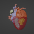 5.png 3D Model of Human Heart with Interrupted Aortic Arch (IAA) - generated from real patient