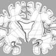 wf4.jpg Alzheimer Disease Brain coronal slice