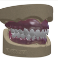 32.png Digital Full Dentures with Combined Glue-in Teeth Arch
