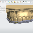 Screenshot_18.png Digital Full Coverage Occlusal Splint with Canine Guidance