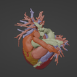 5.png 3D Model of Human Heart with Double Aortic Arch (DAA) - generated from real patient