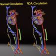 ps-0028.jpg PDA Patent Ductus Arteriosus vs Normal blood circulation
