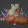 1.png Model of human heart with pulmonary atresia (PuA) - generated from real patient