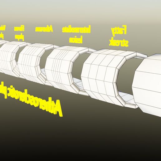 wf-21.jpg Artère Plaque d'athérosclérose et conséquences