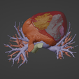 6.png 3D Model of Human Heart with Atrial Septal Defect (ASD) - generated from real patient