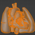 25.png 3D Model of Ventricular Septal Defect