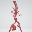 p2.png Case 1 to 6: 3D aortic and iliac artery aneurysm