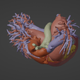 5.png 3D Model of Human Heart with Anomalous Pulmonary Venous Drainage (APVC) - generated from real patient