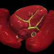 9.png 3D Model of Transposition of the Great Arteries Open Duct
