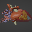 7.png 3D Model of Human Heart with Ventricular Septal Defect (VSD)