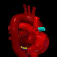 5.png 3D Model of Partial Anomalous Pulmonary Venous Connection