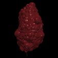 3.jpg 3D Model of Polycystic Kidney