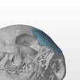 cranio-5.jpg A cranial plate to replace a skull defect (an example of a real operation 2)