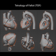 6.TOF1.png Congenital Heart Disease - 7pack
