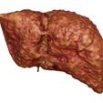 cirrhosis_003-2.png Anatomical model of the liver with cirrhosis