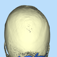 5.png CRANIAL PLATE MADE ACCORDING TO DEFECT