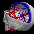 08.jpg 3D Model of Brain Arteriovenous Malformation