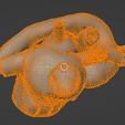 27.png 3D Model of Partial Anomalous Pulmonary Venous Connection