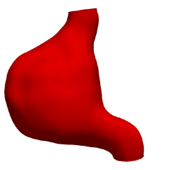 1.png Modèle d'anévrisme de l'aorte abdominale d'un patient réel