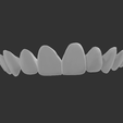 veneers2.png Modèle dentaire avec 10 facettes et articulateur