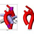 ARSA-V2-03.jpg Aberrant right subclavian artery anomaly 3D print model