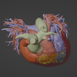 5.png 3D Model of Human Heart with Double Superior Vena Cava (DSVC) - generated from real patient