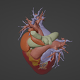 7.png 3D Model of Human Heart with Hypertrophic Cardiomyopathy - generated from real patient