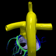 10.png 3D Model of Common Arterial Trunk Truncus Arteriosus
