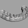Captura-de-tela-2023-10-24-112916.png dental prosthesis