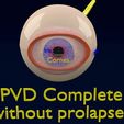 posterior-vitreous-detachment-types-eye-3d-model-blend-70.jpg Posterior vitreous detachment types eye 3D model