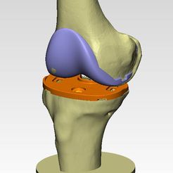 Knee-joint-prosthesis-2.jpg STL file Knee joint prosthesis with guides (sample of individual prosthetics)・3D printing model to download