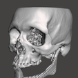 11.png MANDIBLE IMPLANT