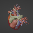 5.png 3D Model of Human Heart with Double Outlet Right Ventricle (DORV) - generated from real patient