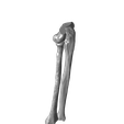 Both_bone_malunion_sag_10_degrees.png Entire collection of simulated forarm angulated malunions
