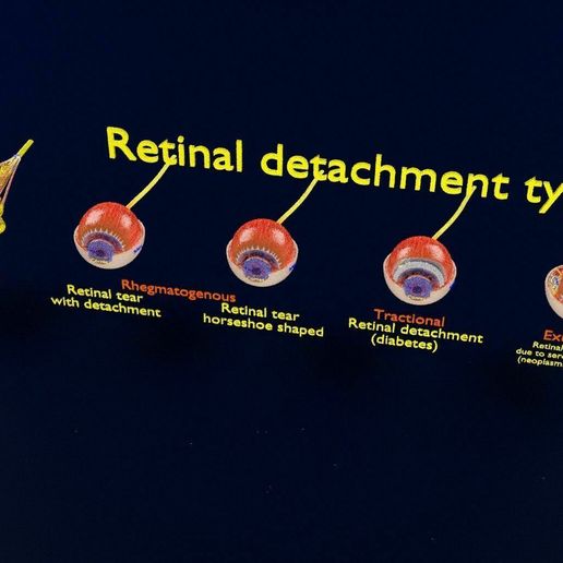 retinal-detachment-types-eye-3d-model-blend-87.jpg Retinal detachment types eye 3D model
