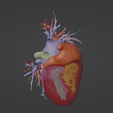 8.png 3D Model of Human Heart with Hypertrophic Cardiomyopathy - generated from real patient