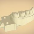 untitled.43.jpg Digital Dental Quadrant  Model with a Full Contour Crown