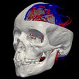 06.jpg 3D Model of Brain Arteriovenous Malformation