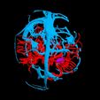 i11.jpg 3D Model of Brain Arteriovenous Malformation