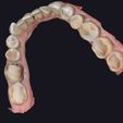 3.jpg colored dental models with periodontitis