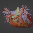 5.png 3D Model of Human Heart with Hypertrophic Cardiomyopathy - generated from real patient